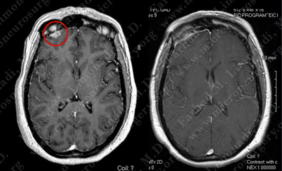 metastatic case11 img5