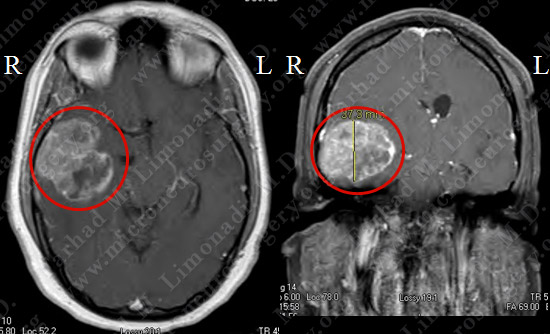 metastatic case12 img1