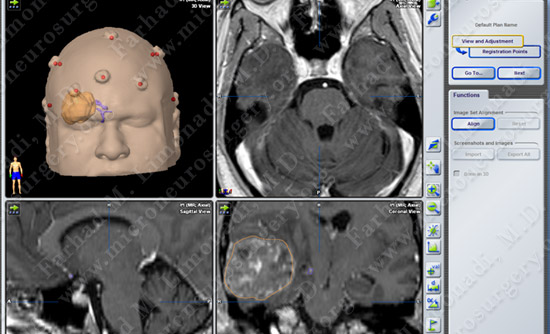 metastatic case12 img2