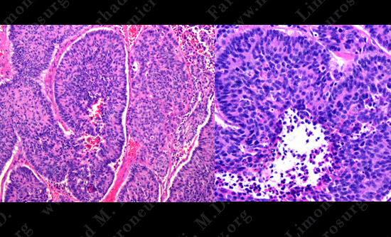 metastatic case12 img3