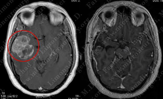 metastatic case12 img4