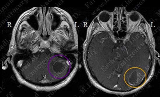 metastatic case13 img1