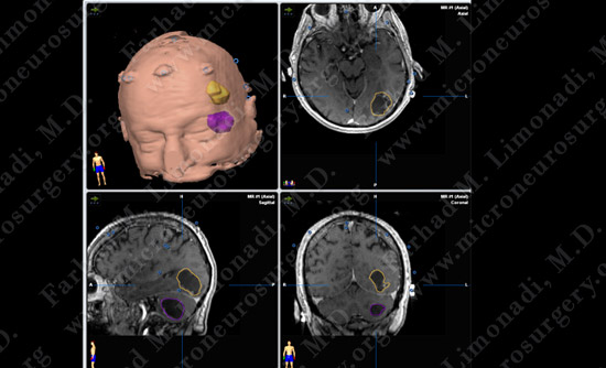 metastatic case13 img2