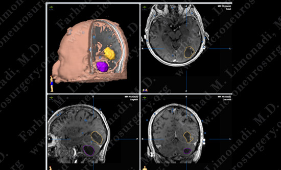 metastatic case13 img3