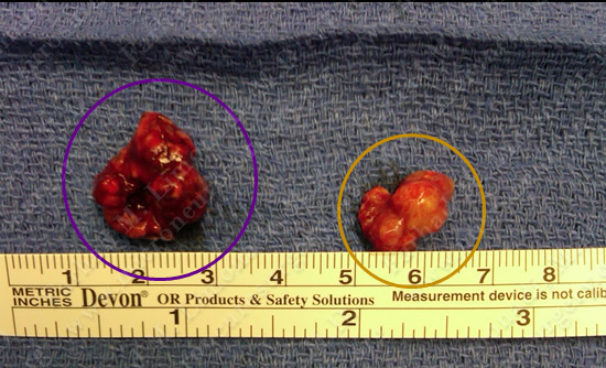 metastatic case13 img4