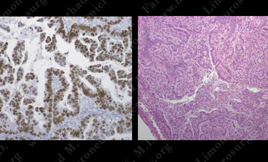 metastatic case13 img5