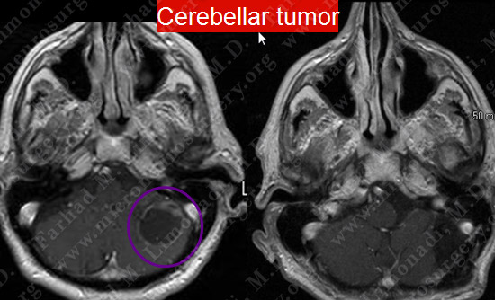 metastatic case13 img6