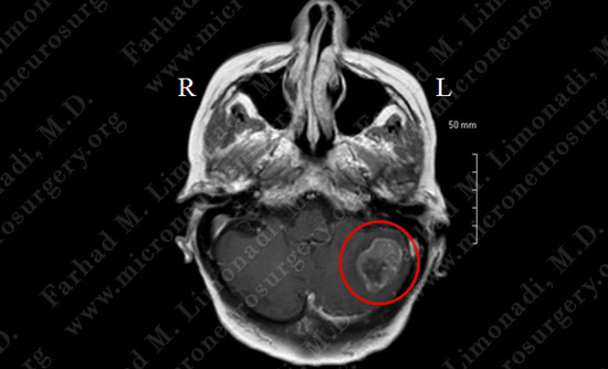 metastatic case9 img1