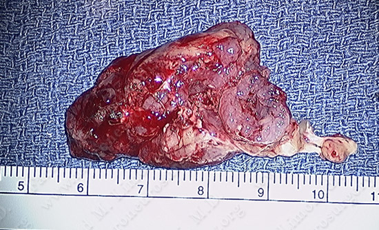 metastatic case9 img2