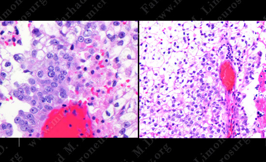 metastatic case9 img3