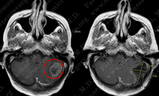 metastatic case9 img4