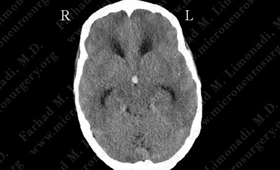 colloidcyst-case2-001