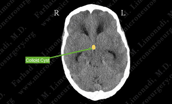 colloidcyst-case2-002