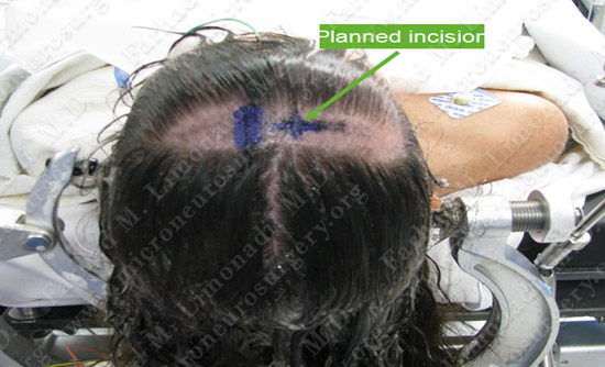 colloidcyst-case2-005