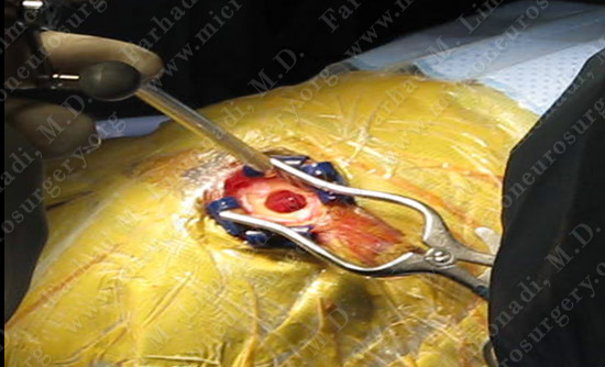 colloidcyst-case2-006