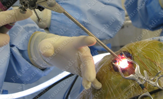 colloidcyst-case2-007