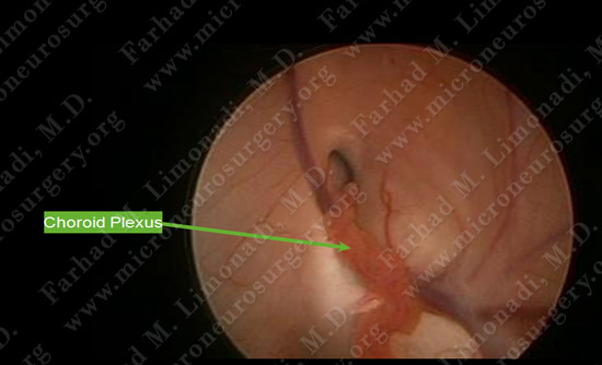 colloidcyst-case2-009