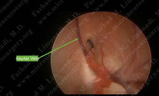colloidcyst-case2-010