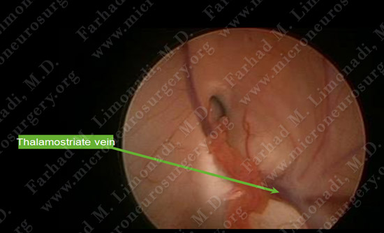 colloidcyst-case2-011