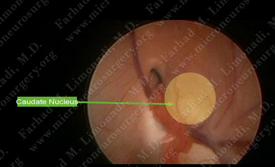 colloidcyst-case2-012