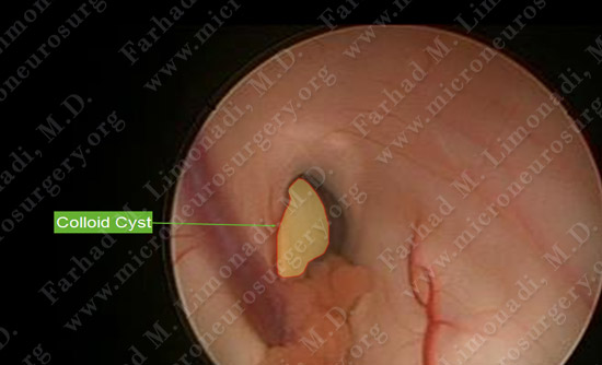 colloidcyst-case2-013