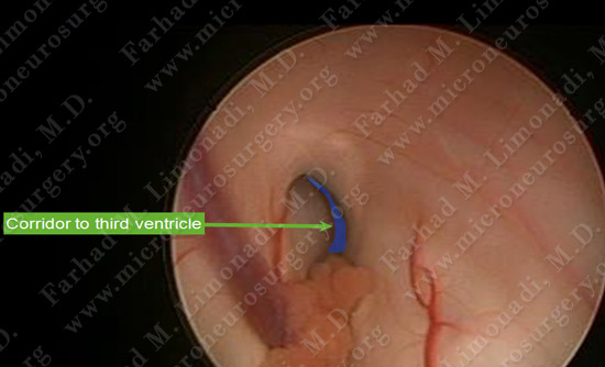 colloidcyst-case2-014