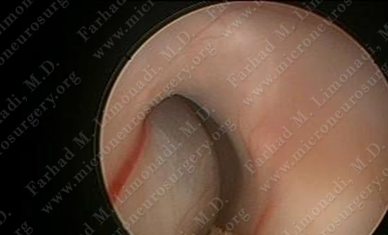 colloidcyst-case2-015