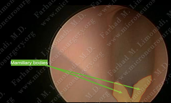 colloidcyst-case2-016