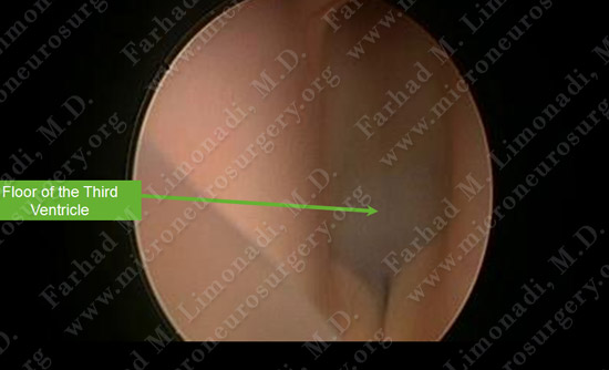 colloidcyst-case2-019