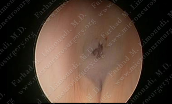 colloidcyst-case2-020