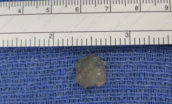 colloidcyst-case2-022