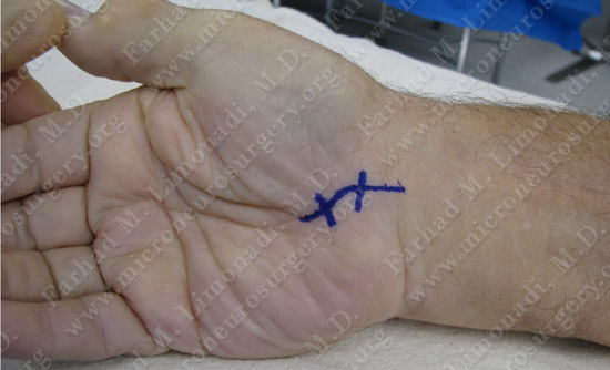 Carpal Tunnel Syndrome Case Image 1