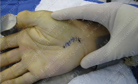 Carpal Tunnel Syndrome Case Image 2