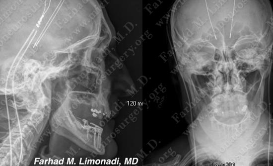 Parkinsons-case2-008