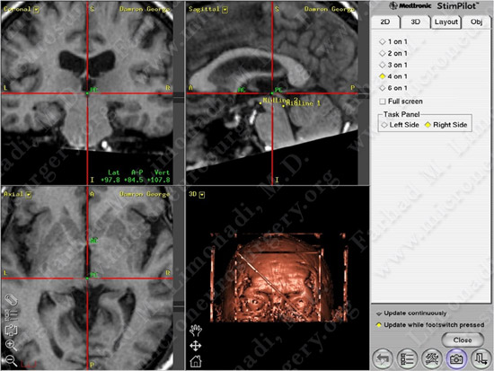 Parkinson's Disease Case 1 Image 10