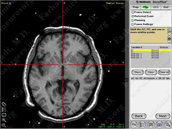 Parkinson's Disease Case 1 Image 11