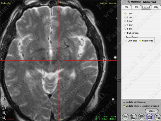 Parkinson's Disease Case 1 Image 12