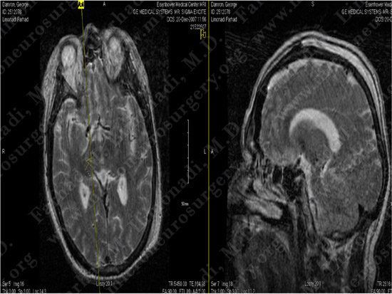 Parkinson's Disease Case 1 Image 19