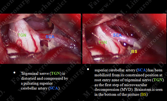 trigeminal case3 img3